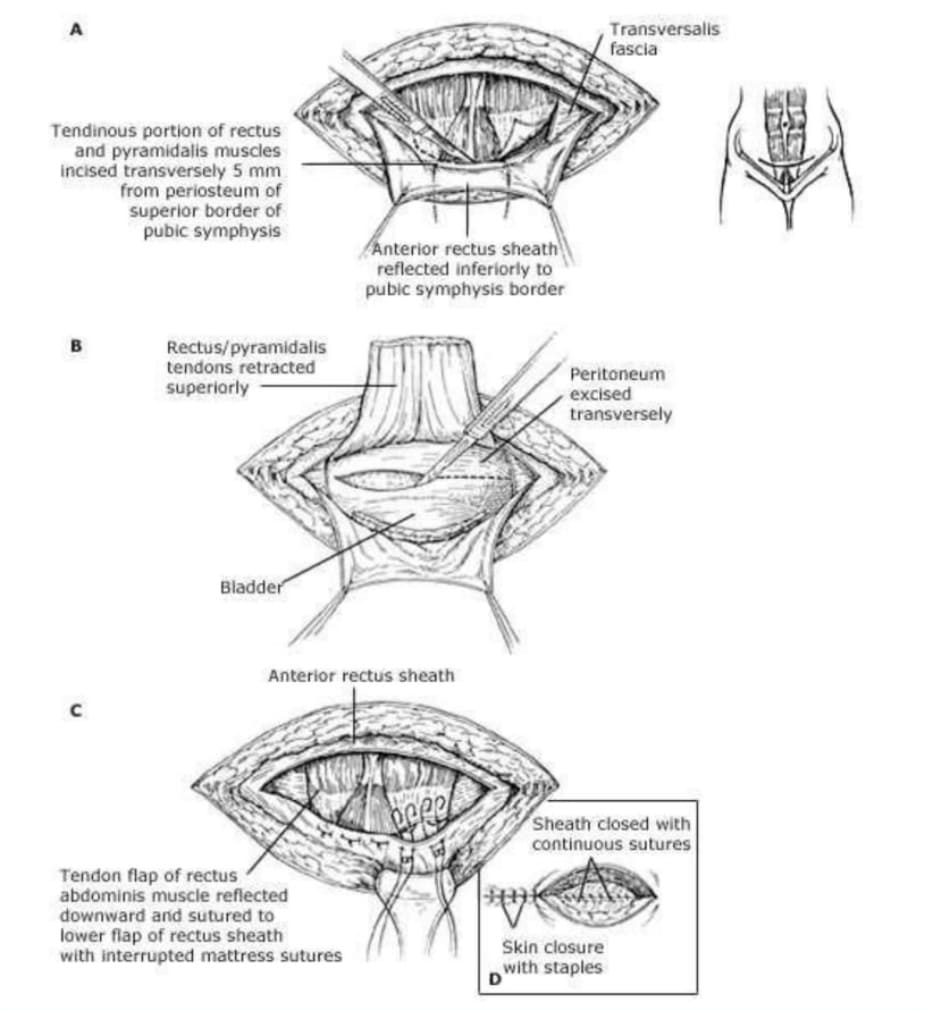 Cherney incision