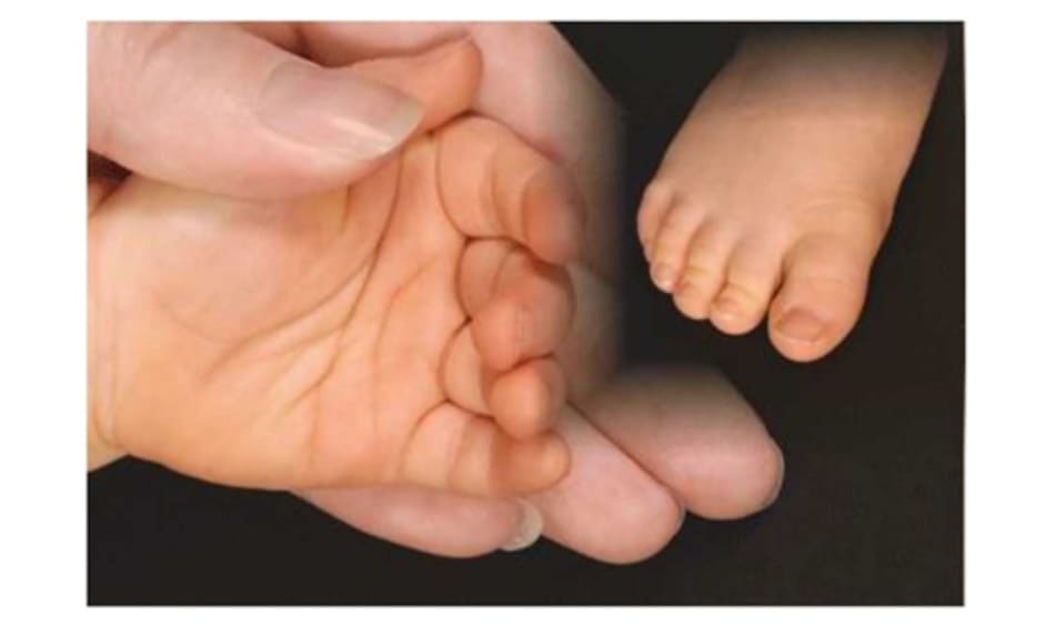 Hình 3: Sự đổi màu vàng cam ở lòng bàn tay và lòng bàn chân tương phản với màu da bình thường của mẹ