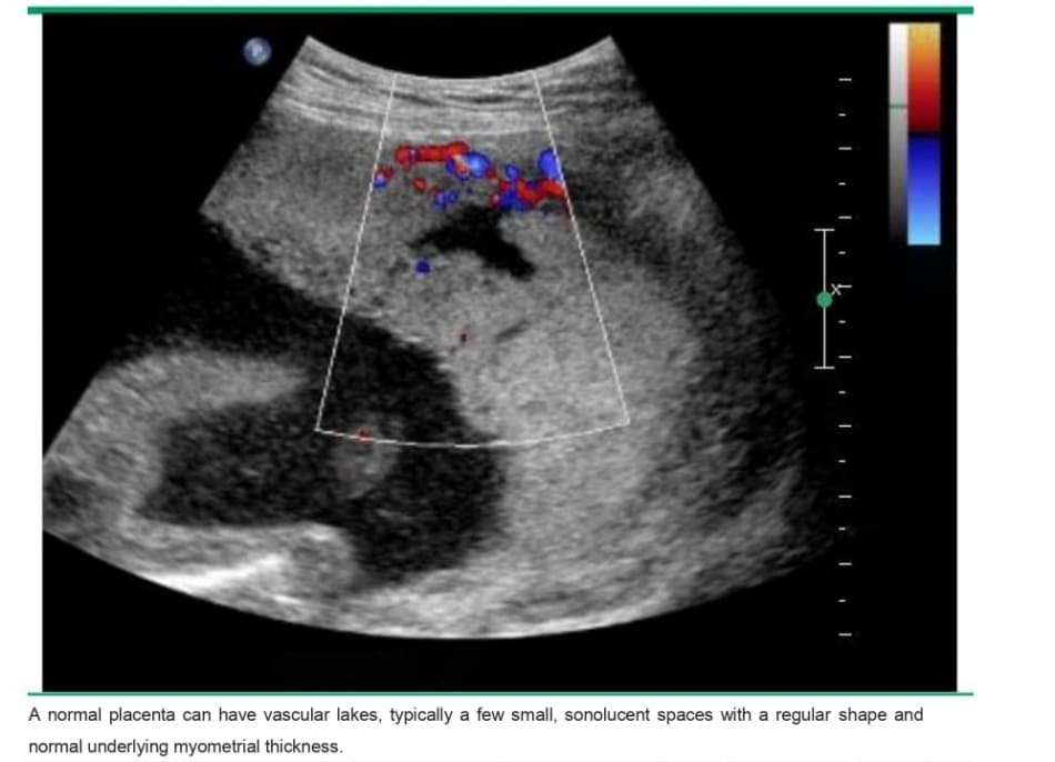 Single venous lake in a normal placenta
