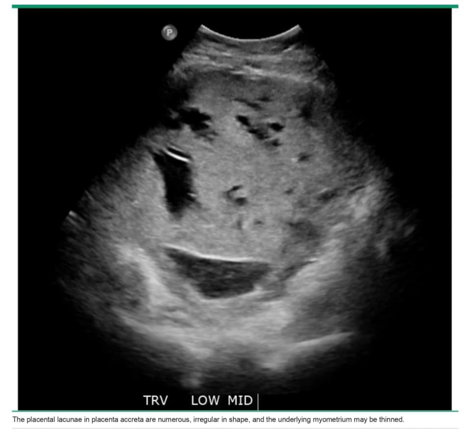 Multiple, irregular placental lacunae in placenta accreta