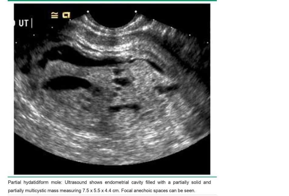 Ultrasound image of partial hydatidiform mole