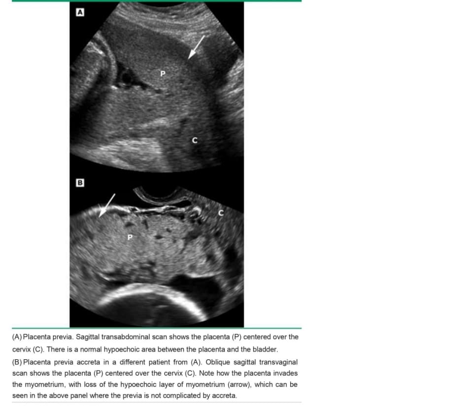 Sonogram of placenta previa and placenta previa accreta