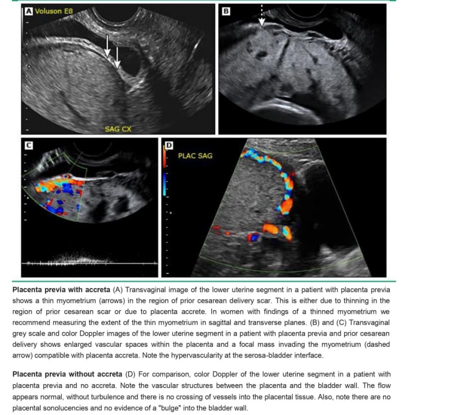 Ultrasound and Doppler images of placenta accreta