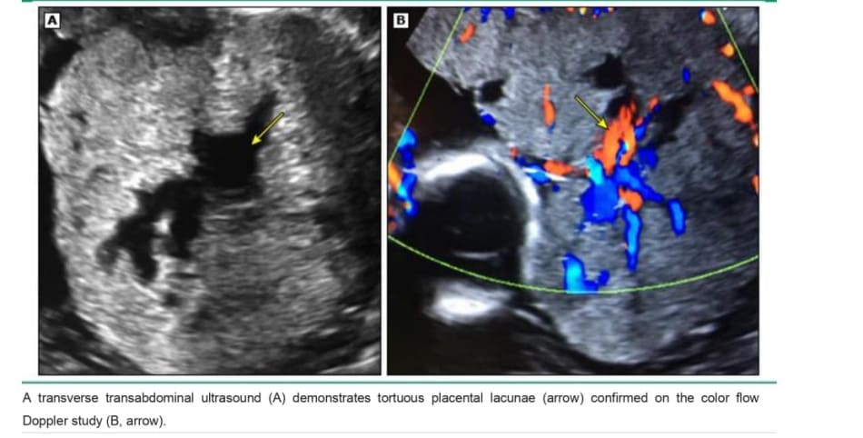 Placental lacunae in placenta increta