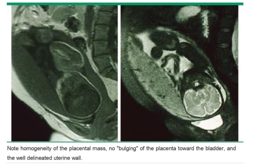 Magnetic resonance image of normal placental attachment (no accreta)