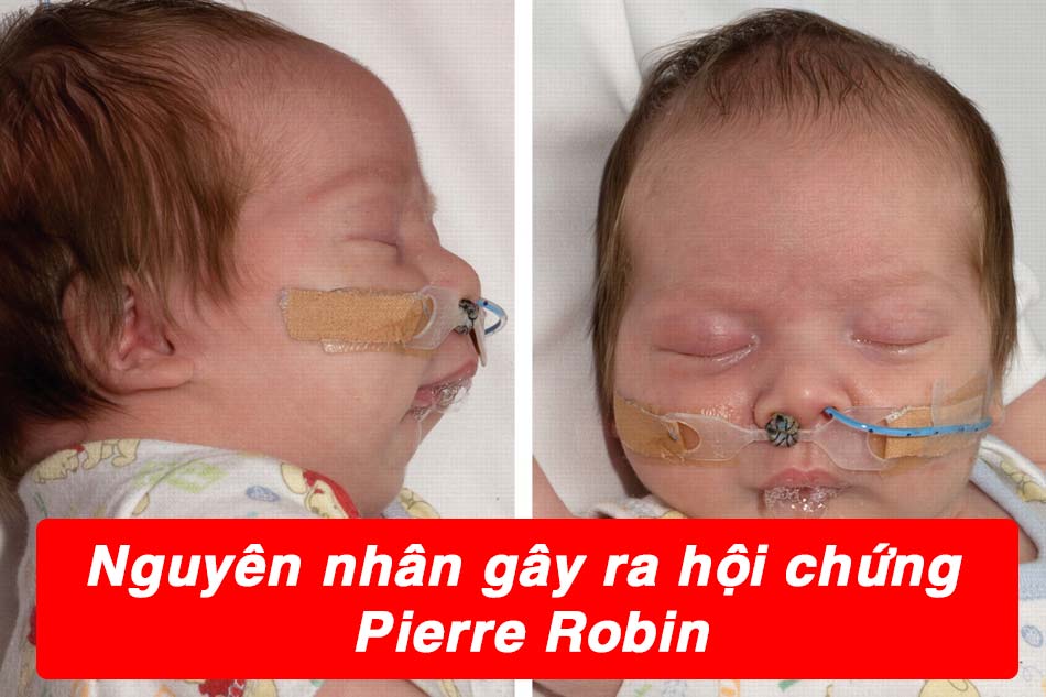 Nguyên nhân trẻ mắc hội chứng Pierre Robin