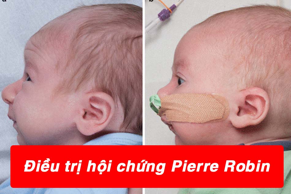 Điều trị cho trẻ mắc hội chứng Pierre Robin