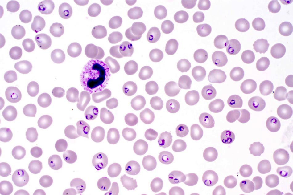 Plasmodium Falciparum