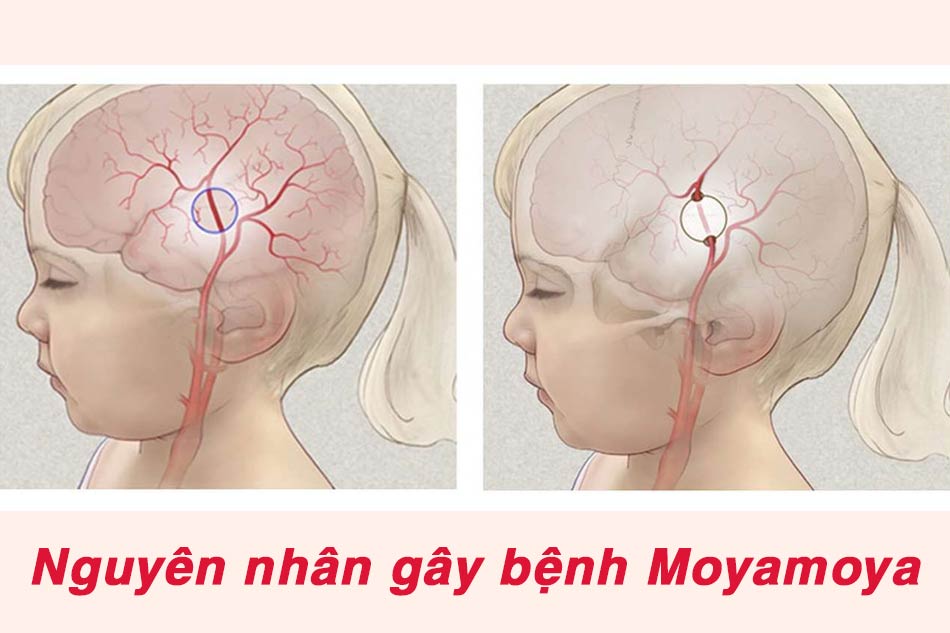 Nguyên nhân gây nên bệnh Moyamoya