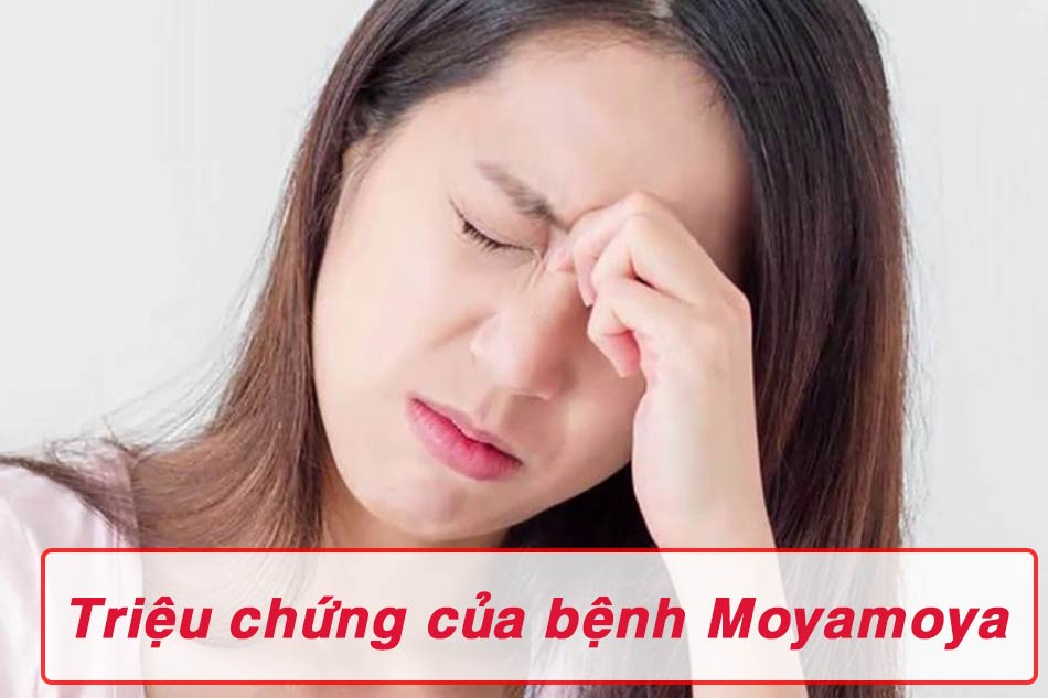 Các triệu chứng của bệnh moyamoya