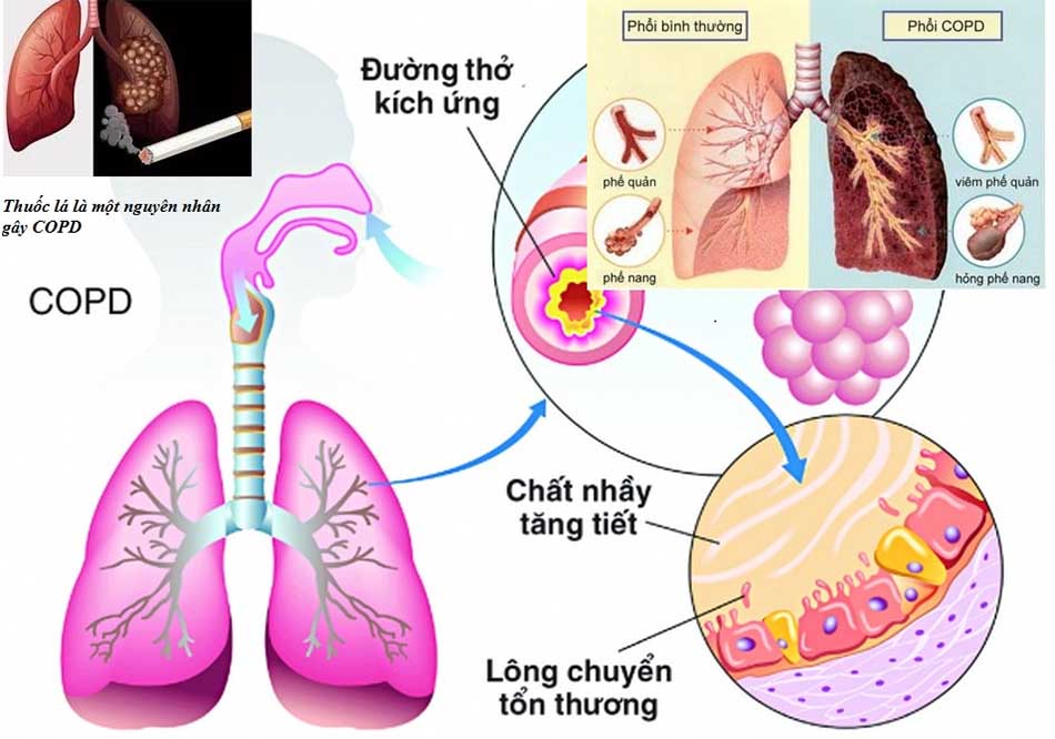 Bệnh phổi tắc nghẽn mãn tính