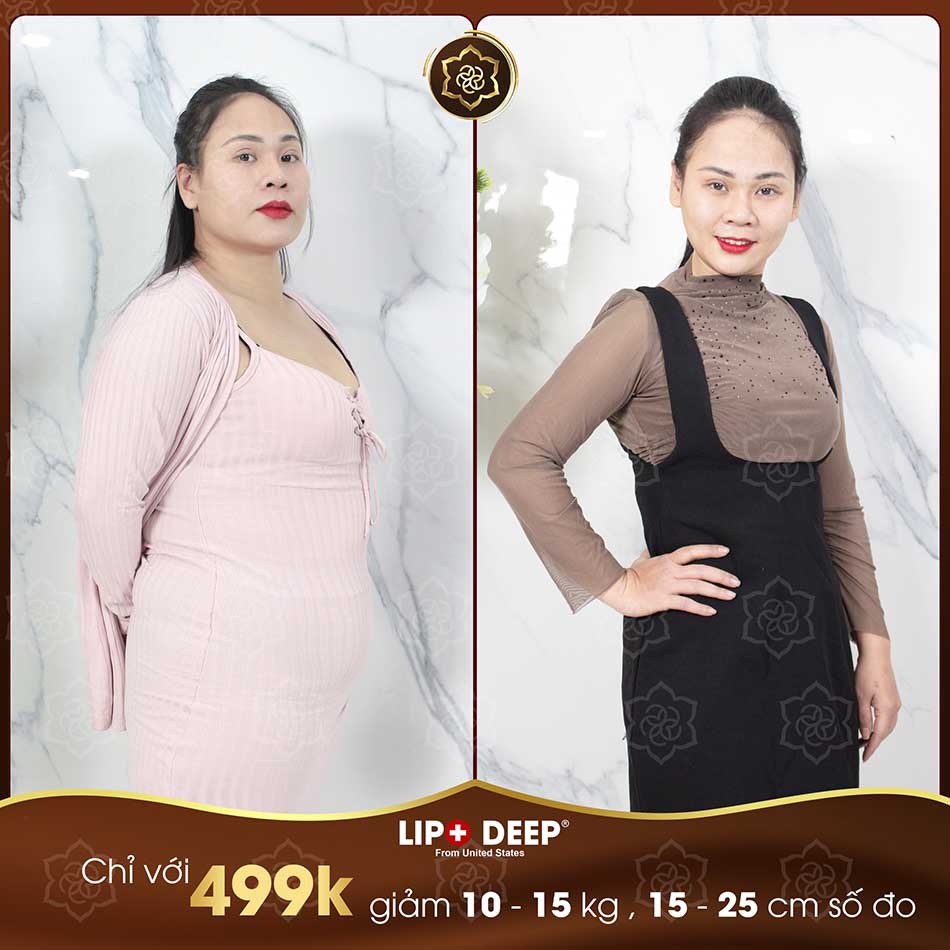 Hình ảnh KH đã sử dụng liệu trình giảm béo CN cao – LIPO DEEP