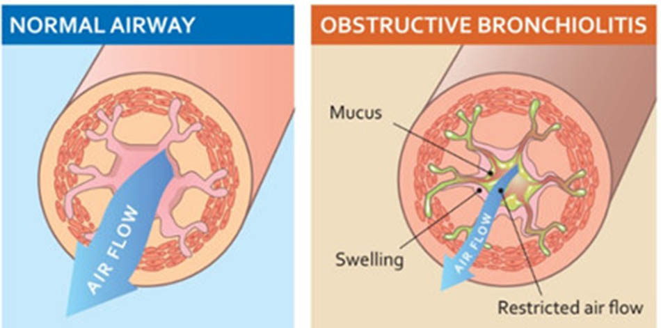 Ảnh: Đường dẫn khí ở người bình thường và bệnh nhân mắc COPD.