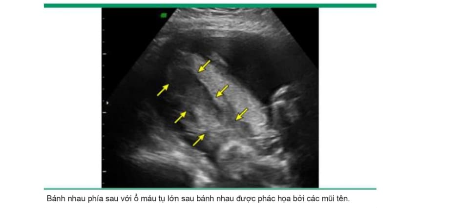 Hình ảnh siêu âm máu tụ sau bánh nhau