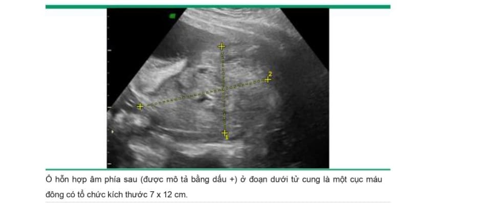 Tổ chức máu tụ trong từ cung