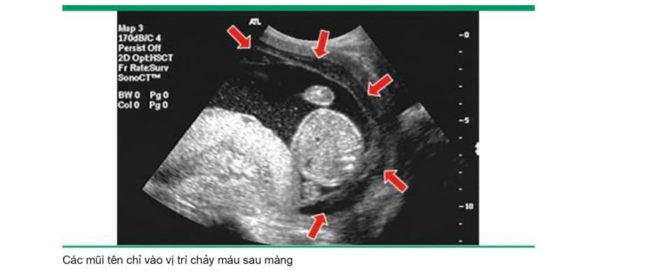 Chảy máu sau màng 2