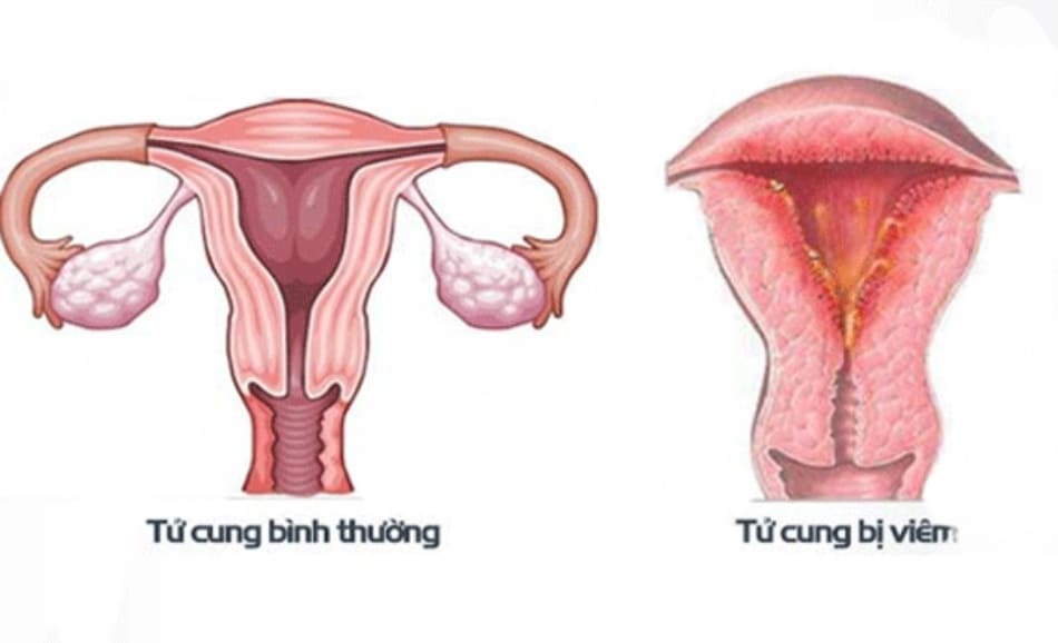 Hình ảnh viêm nội mạc tử cung