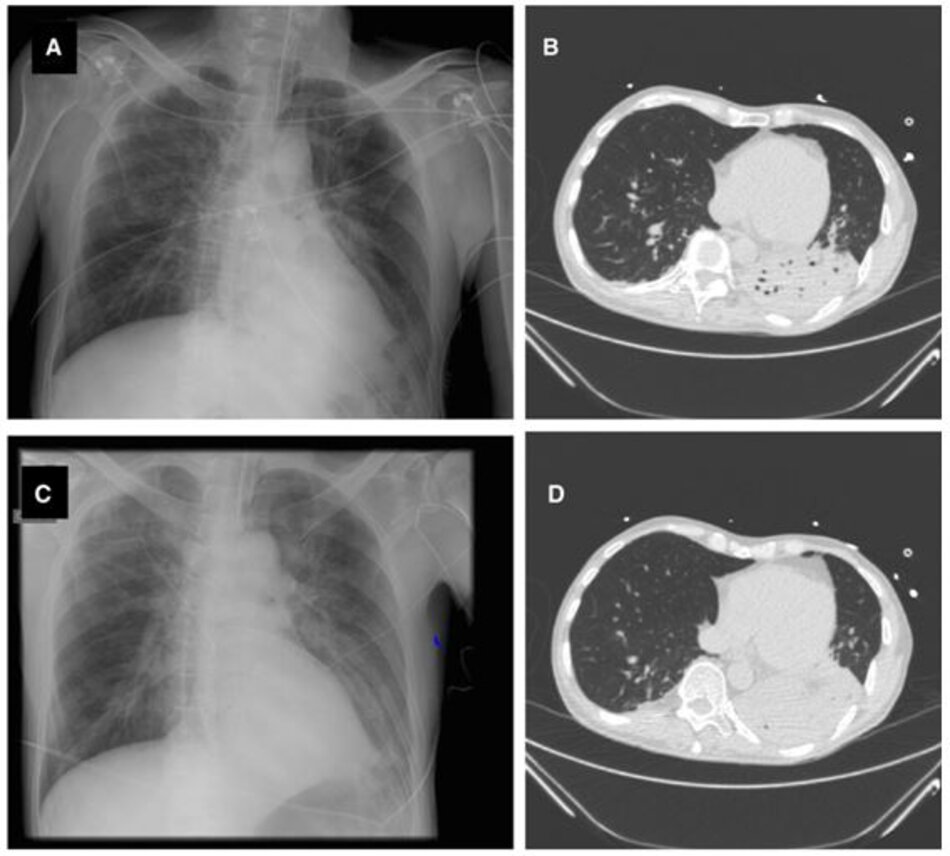 Hình 1 Chụp X-quang và CT-scan ngực của một người đàn ông 65 tuổi bị viêm phổi do thở máy. Chụp X-quang ngực được thực hiện vào ngày nghi ngờ VAP có vẻ bình thường (a), trong khi CT-scan được thực hiện cùng ngày cho thấy sự đông đặc của thùy dưới bên trái (b, d). Rửa phế quản phế nang thu được 105 Enterobacter aerogenes. Ngày hôm sau, chụp X- quang phổi cho thấy tiến triển của thâm nhiễm phổi (c). Chẩn đoán VAP dựa trên X-quang phổi sẽ bị trì hoãn