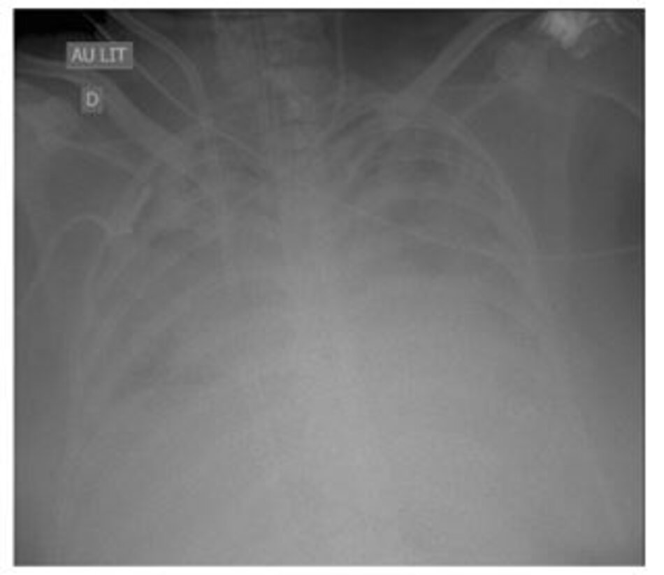 Hình 2 Chụp X-quang ngực của một phụ nữ 35 tuổi bị hội chứng suy hô hấp cấp tính do cúm H1N1 (“phổi trắng”). Cô ấy bị sốt, tăng bạch cầu, dịch tiết khí quản có mủ và rửa phế quản phế nang (thu được trong quá trình nội soi phế quản bằng sợi quang) cho kết quả 105 Pseudomonas aeruginosa. Chụp X-quang ngực không thay đổi (chụp X-quang ngực giống như vậy kể từ 1 tuần) và rõ ràng là không hữu ích để nghi ngờ/chẩn đoán viêm phổi liên quan đến máy thở