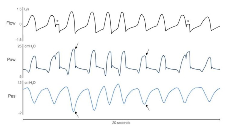 Hình 1 Ví dụ về nguyên lý làm việc của thông khí hỗ trợ tỷ lệ với hệ số khuếch đại điều chỉnh theo tải (PAV+). Các thủ thuật tắc ngắn trong quá trình hít vào được thực hiện tự động (được biểu thị bằng dấu * trong tín hiệu lưu lượng) để tính toán sức cản và độ giãn nở của hệ thống hô hấp. Các mũi tên chỉ ra rằng áp lực đường thở (Paw) được cung cấp tỷ lệ thuận với nỗ lực của bệnh nhân (áp lực thực quản (Pes))