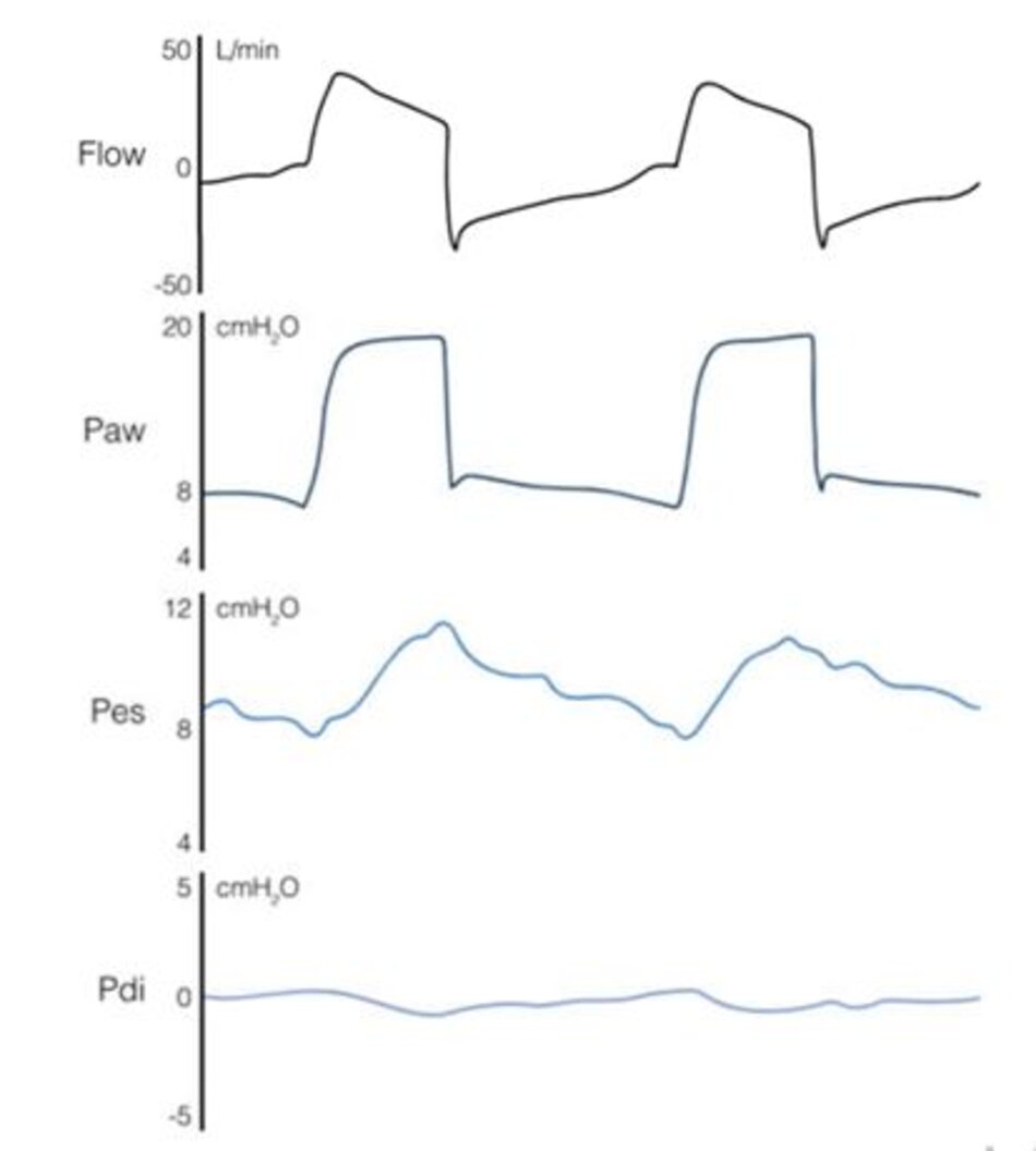 Hình 3 Ví dụ điển hình về hỗ trợ quá mức trong quá trình thông khí hỗ trợ áp lực (PSV). Bệnh nhân được thở máy với áp lực hít vào đặt 10 cmH2O trên áp lực dương cuối thì thở ra 8 cmH2O. Một ống thông mũi dạ dày hai bóng được đặt để đo áp lực thực quản (Pes) và áp lực dạ dày. Áp lực cơ hoành (Pdi) được tính bằng áp lực dạ dày trừ đi Pes. Như có thể thấy trong dạng sóng Pes, bệnh nhân chỉ khởi động máy thở (giảm Pes nhỏ) và thư giãn các cơ hô hấp sau đó, được chứng minh bằng sự gia tăng Pes trong thời gian còn lại của chu kỳ thở và không có sự gia tăng Pdi.