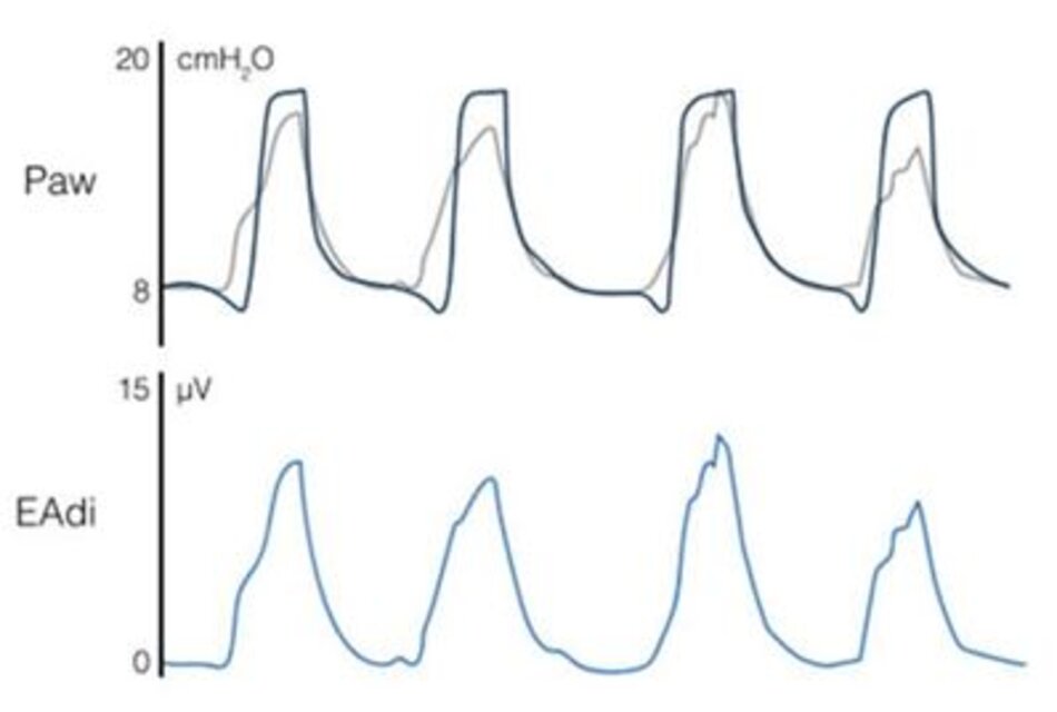 Hình 4 Ví dụ về bản xem trước hỗ trợ thông khí được điều chỉnh bằng thần kinh (NAVA) trong quá trình thông khí hỗ trợ áp lực (hỗ trợ hô hấp 10 cmH2O trên áp lực dương cuối thì thở ra là 8 cmH2O). Đường cong màu xám cho thấy “bản xem trước” của áp lực đường thở ước tính (Paw) sẽ tồn tại nếu bệnh nhân được thở máy ở chế độ NAVA. Hình dạng của đường cong Paw này giống với đường cong hoạt động điện cơ hoành (EAdi) (tức là tỷ lệthuận). Số lượng hỗ trợ phụ thuộc vào biên độ EAdi và mức NAVA đã chọn (0,8 cmH2O/µV cho ví dụ này)