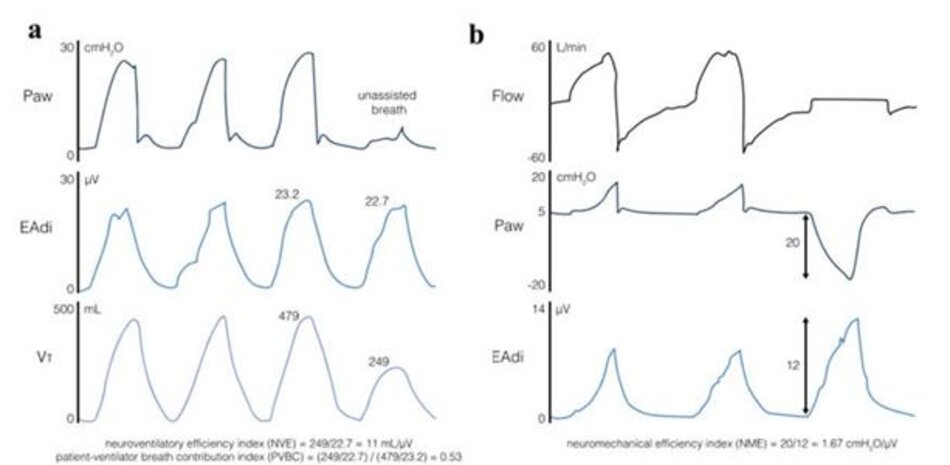 Hình 5 a Ví dụ về các tính toán của chỉ số hiệu quả thần kinh - thông khí (NVE) và chỉ số đóng góp vào nhịp thở của bệnh nhân thở máy (PVBC). Nhịp thở không có trợ giúp đạt được bằng cách giảm mức hỗ trợ thông khí được điều chỉnh bằng thần kinh xuống 0 trong một lần thở. NVE được tính bằng tỷ số giữa thể tích khí lưu thông với hoạt động điện đỉnh của cơ hoành (EAdi). Khi chia NVE này cho tỷ lệ giữa thể tích khí lưu thông và EAdi của nhịp thở hỗ trợ trước đó, ta sẽ có được chỉ số PVBC. b Ví dụ về việc tính toán chỉ số hiệu quả thần kinh-cơ học (NME) trong thủ thuật giữ cuối thì thở ra. Trong quá trình tắc (lưu lượng bằng không), tỷ số giữa delta áp lực đường thở (Paw) và EAdi đại diện cho NME