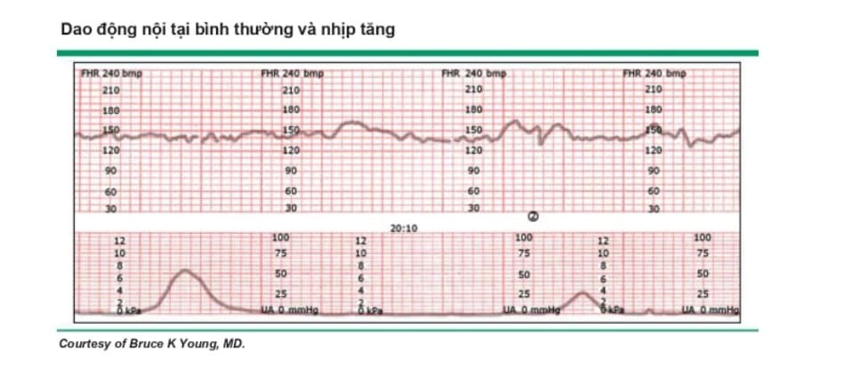 Dao động nội tại binh thường và nhịp tăng