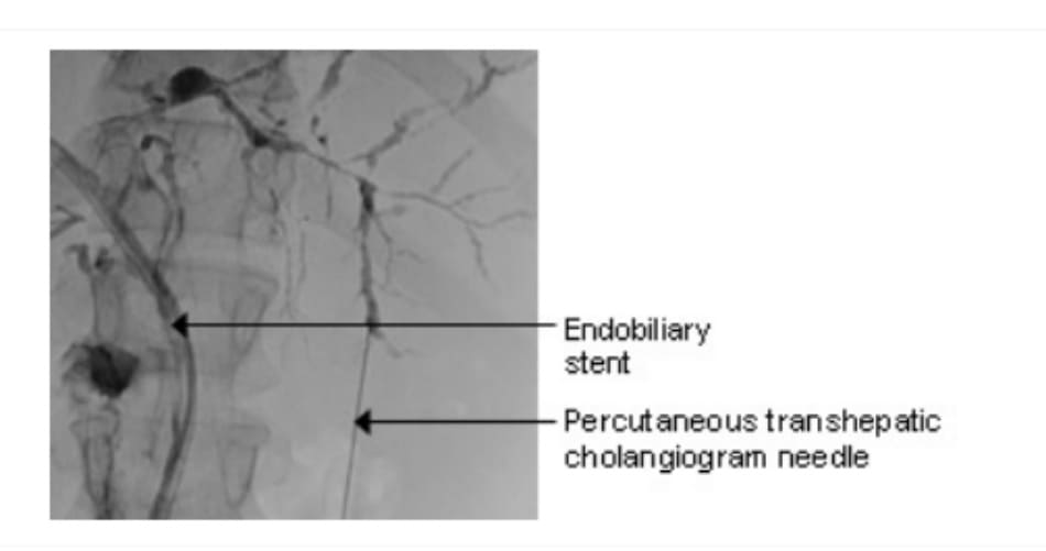 Hình 7: Kết quả điển hình qua ERCP ở bệnh nhân bị viêm xơ đường mật nguyên phát: co thắt ống mật trong gan và ngoài gan, dạng đa ổ.