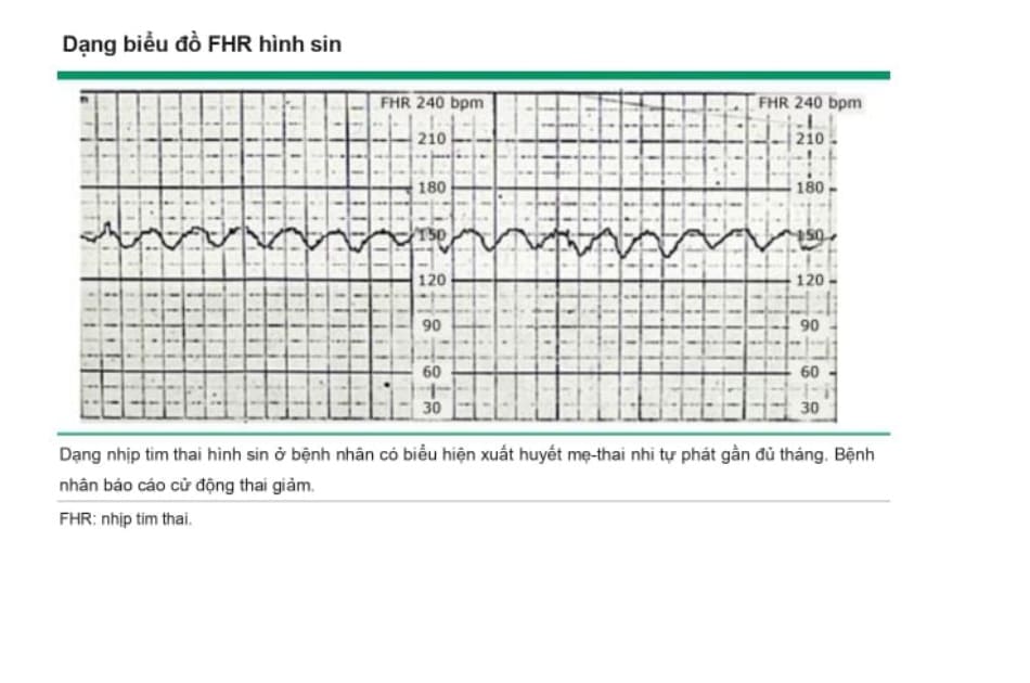 Dạng biểu đồ FHR hình sin