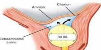 Khởi phát chuyển dạ: Tổng quan các hướng dẫn trong khoa sản