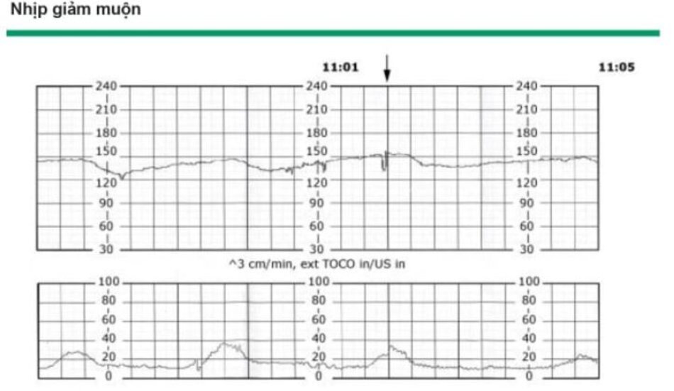 Nhịp giảm muộn được đặc trưng bởi sự giâm từ từ vã trở vè đường cơ bản của nhịp tim thai liên quan với các cơn co tử cung. Nhịp giảm muộn bị trẻ về thời gian, với đây của nhịp giảm muộn xảy ra sau đình của cơn co. Khởi phát, đái vã hồi phục thường xảy ra sau khởi đầu, đình vả kết thúc cơn co. Trong ví dụ nãy, dao động nội tại lả tối thiểu.