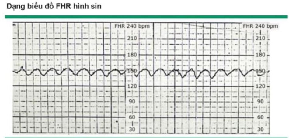 Dạng biểu đồ FHR hình sin