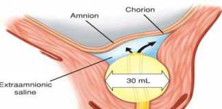 Khởi phát chuyển dạ: Tổng quan các hướng dẫn về khởi phát chuyển dạ