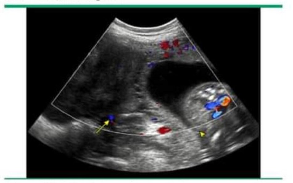 Ultrasound with color Doppler image of ovarian torsion in a pregnant woman. Arrow shows an ovary with no vascularity. Arrowhead shows the fetus 