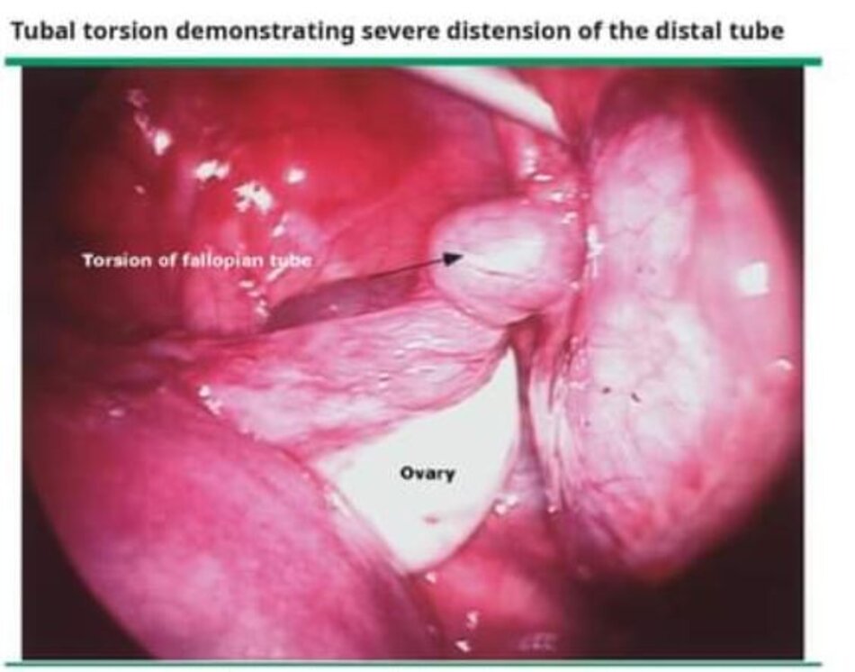 Tubal torsion demonstrating severe distension of the distal tube