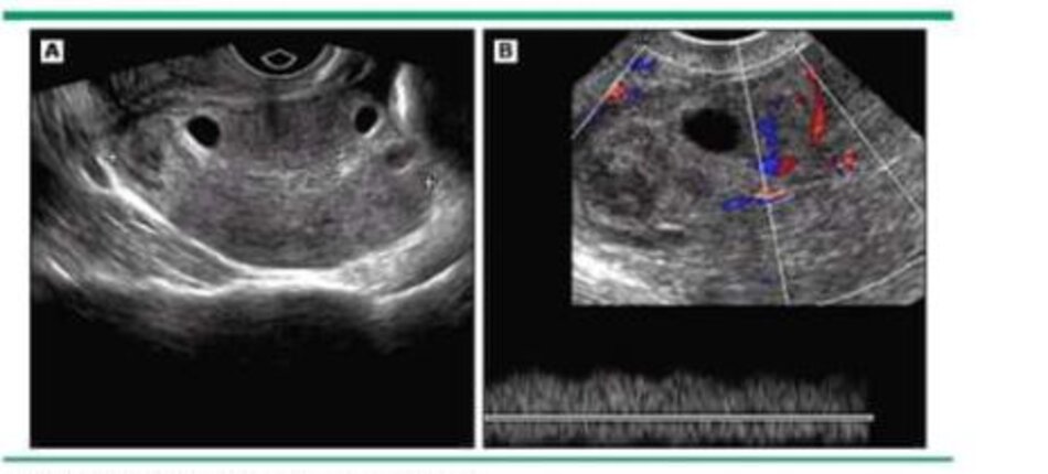 A 35-year-old woman with pelvic pain and torsion. (A)Transvaginal ultrasound shows an enlarged (7 cm) edematous appearing right ovary in the cul- de-sac. (B) Color Doppler shows normal arterial and venous waveforms. Torsion was confirmed at surgery.