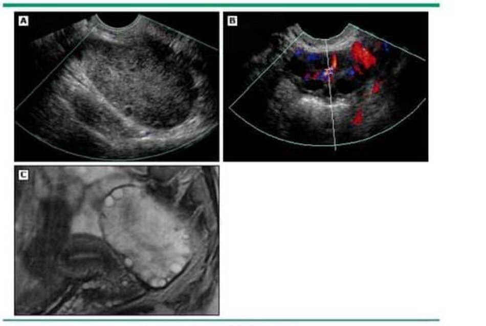 A 32-year-old with right lower quadrant pain and right ovarian torsion (A) Transvaginal color Doppler ultrasound shows an enlarged edematous appearing right ovary Without demonstrable flow. (B) Transvaginal color Doppler ultrasound of the left ovary shows a normal sized ovary with normal flow. (C) T2-weighted magnetic resonance image shows the enlarged edematous ovary With peripheral cysts.