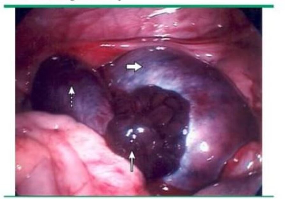 Ovarian and tubal torsion demonstrating marked vascular engorgement as well as increased size and distension. Anatomy was restored, and both structures were salvaged despite nonviable appearance. The thick arrow shows the torsed, enlarged ovary (viable). The dashed arrow shows the enlarged fallopian tube (viable). The arrow shows the enlarged fimbria of the fallopian tube (viable).