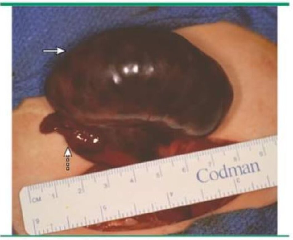 Enlarged viable left ovary found torsed upon laparotomy demonstrating a dark, dusky appearance secondary to venous lymphatic congestion In the setting of continued arterial perfusion. The solid arrow denotes the viable ovary; the dashed arrow denotes the viable fallopian tube.