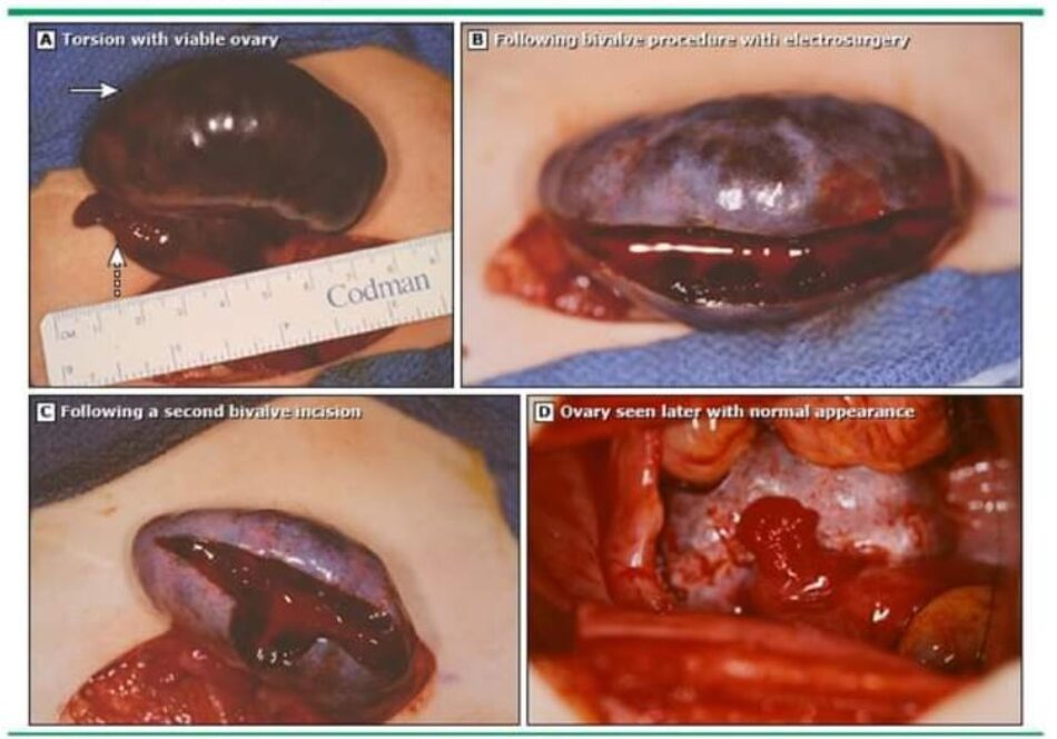 Ovarian torsion: Assessing perfusion with the bivalve technique