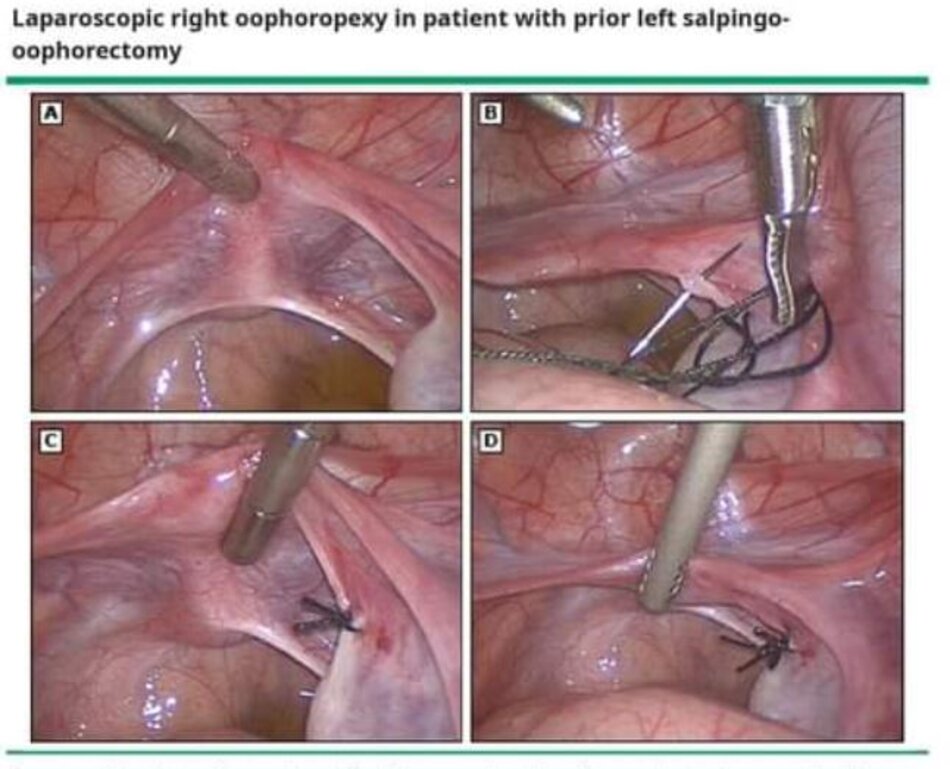 Laparoscopic right oophoropexy in patient with prior left salpingo- oophorectomy