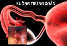 Xoắn buồng trứng và ống dẫn trứng trong phụ khoa