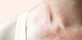 Viêm da dị ứng là một trong những bệnh về da liễu phổ biến hiện nay