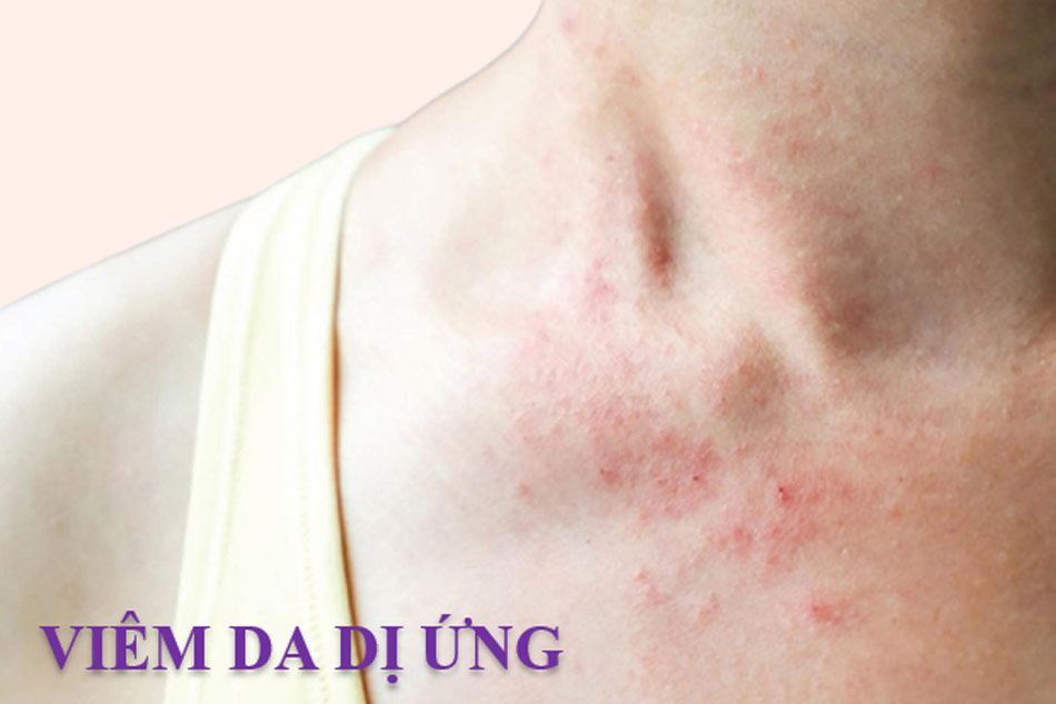 Viêm da dị ứng là một trong những bệnh về da liễu phổ biến hiện nay