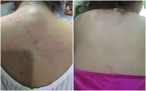 Hình ảnh trước và sau quá trình điều trị viêm nang lông của chị Minh Anh 
