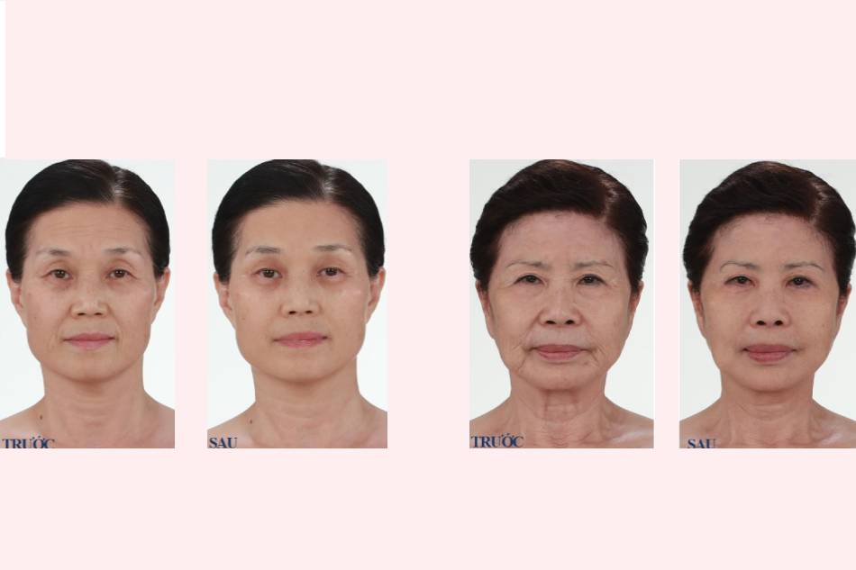 Cải thiện da sau 2 tuần sử dụng Premium Wrinkle Power Lifting Mask 