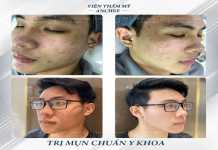 Hình ảnh trị mụn cho nam