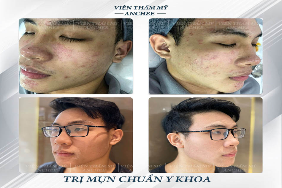 Hình ảnh trị mụn cho nam 